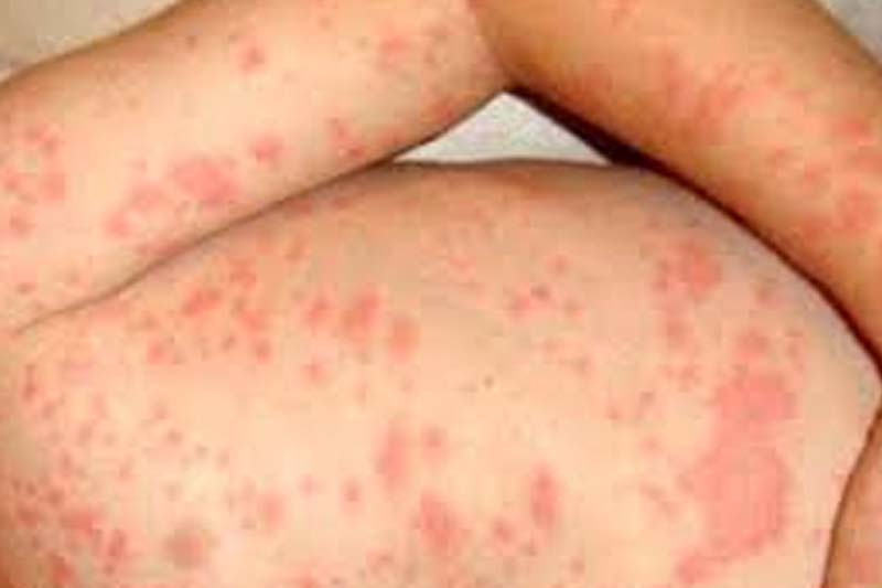 وزارة الصحة تسجل انخفاضًا متواصلًا في حالات الإصابة بفيروس بوحمرون